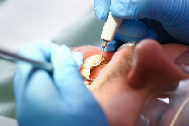 Best Emergency Dental Care for Abscessed Tooth in Rapid Valley, SD