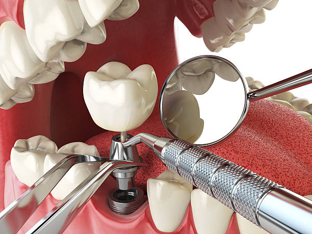 Best Emergency Dentist for Lost Fillings or Crowns in Rapid Valley, SD